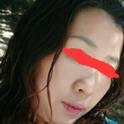 北京邦定張亞昆做的面部提升，果較為不錯~